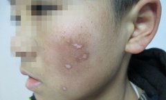 面部白癜风怎么护理好?